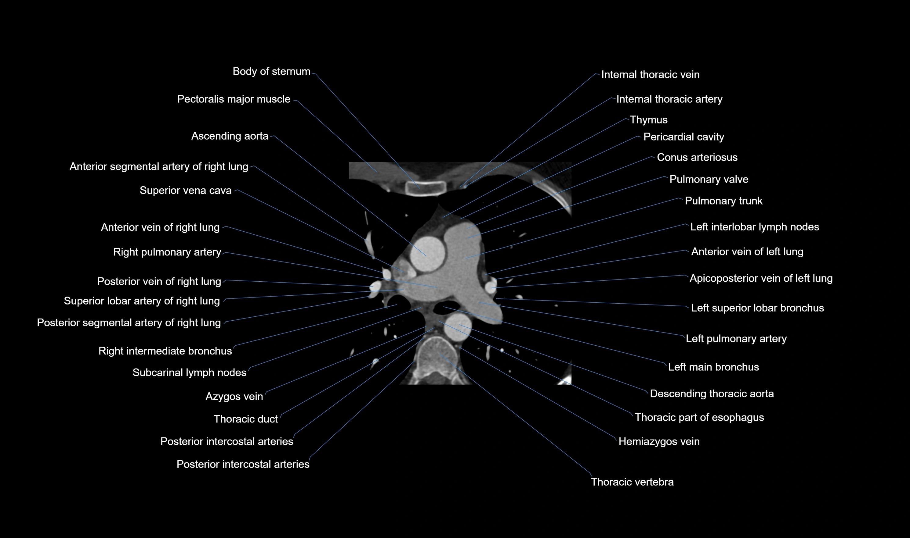 CT heart (coronary angiogram) axial view cross sectional anatomy labelled radiology image-00012.webp